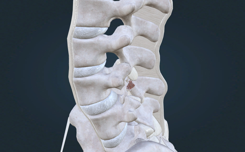 45° degrees oblique view of the lumbar spine - escena en 3D