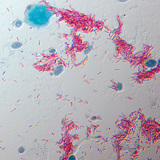Палочка Коха, возбудитель туберкулёза (Mycobacterium tuberculosis – МБТ)