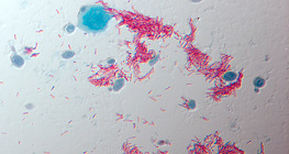 Patogeno della tubercolosi (Mycobacterium tuberculosis - bacillo di Koch)