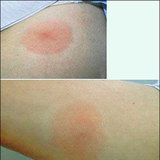 Lyme disease