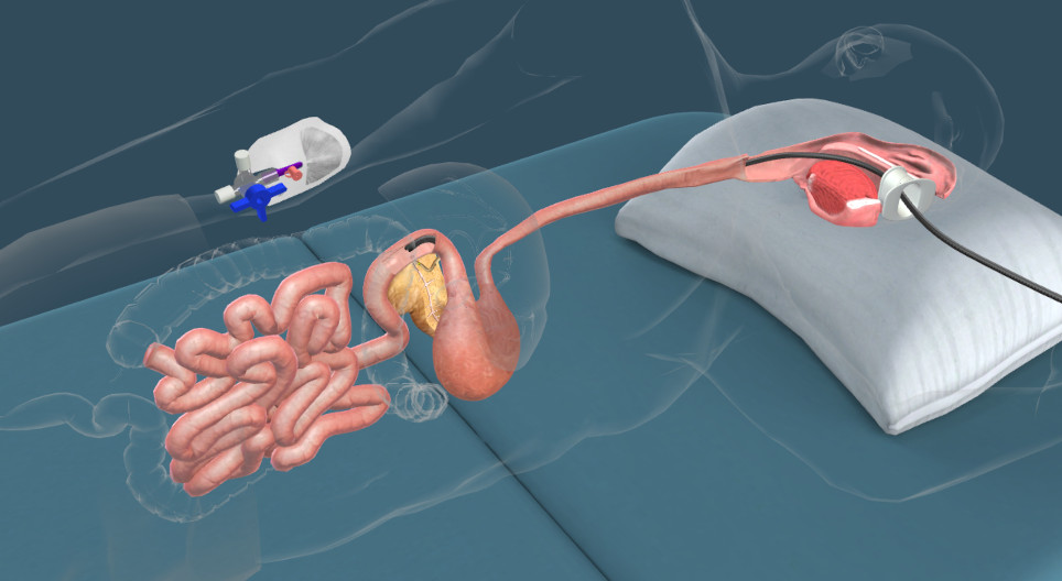 ERCP examination