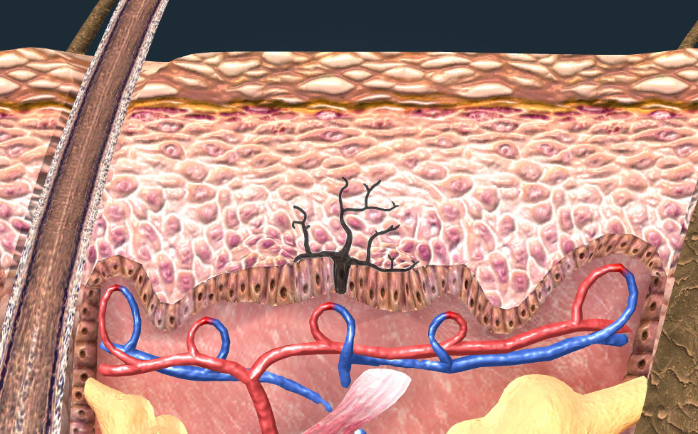 Rjavenje kože, kožni rak - 3D-animacija - Digitalno poučevanje in ...